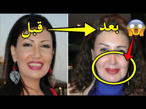 شاهد فنانة مصرية تروي مأساتها مع عمليات التجميل