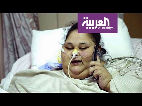 بالفيديو أسمن فتاة في العالم تعاني من خلل جيني يعوق علاجها