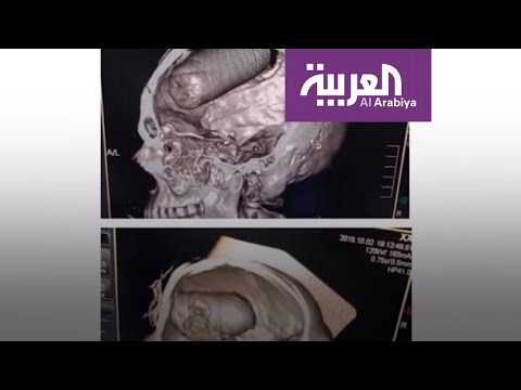 شاهد تحدي الدايت صودا واختراق جماجم العراقيين