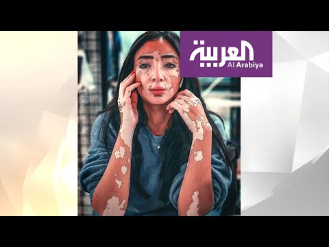 شاهد مدونة مصرية حولت إصابتها بالبهاق إلى نجاح